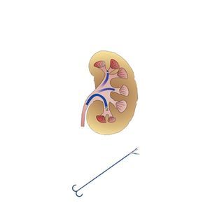 Ureterzugangsschaft