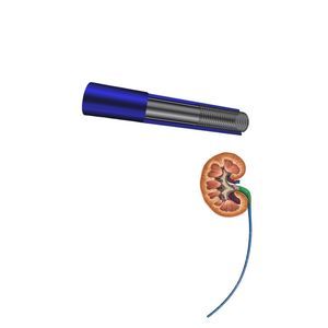 Ureterzugangsschaft