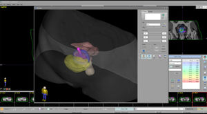 Software für Brachytherapie 1