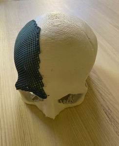 patientenspezifisches Schädelimplantat