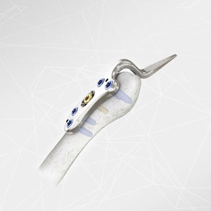Kompressionsplatte für Acromioclaviculargelenk 1