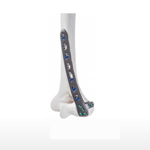 Kompressionsplatte für Humerus 1