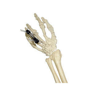 Fixateur externe für Fingergrundgelenk 1