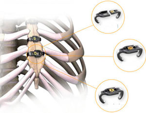 Cerclagekabel für Sternum-Verschluss