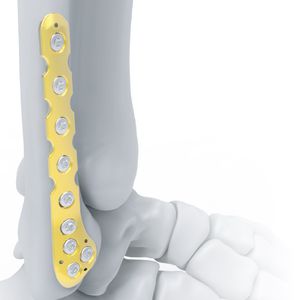 Knochen-Kompressionsplatte / Fibula / distal