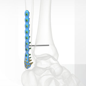 Kompressionsplatte für Fibula