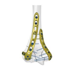 Kompressionsplatte für Humerus 1