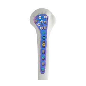 Kompressionsplatte für Humerus 1