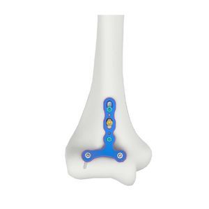 Osteotomieplatte für Humerus 1
