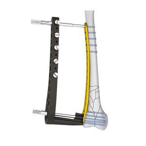 Osteotomieplatte für Oberschenkelknochen 1