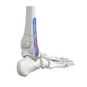 Osteotomieplatte für Fibula 1