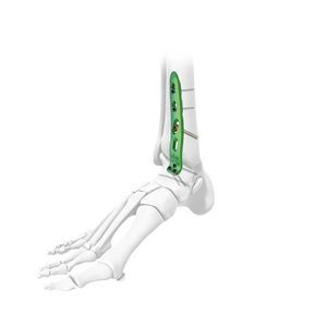 Arthrodeseplatte für Knöchel