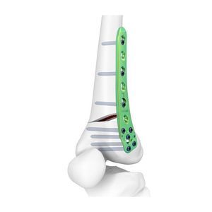 Osteotomieplatte für Oberschenkelknochen