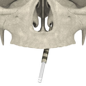 Bohrer für Dentalimplantologie 1