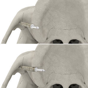 Bohrer für Implantatosteotomie 1