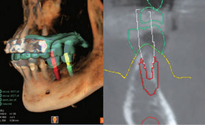 Planungssoftware / dental- implantologische Planung / FAO / für Zahnprothese-Design