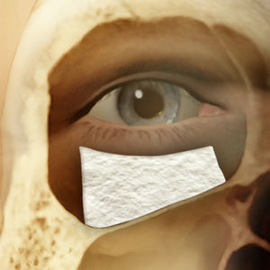 Xenograft-Knochenersatzmaterial