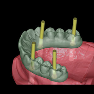 Software-Modul / für Dentalimplantologie