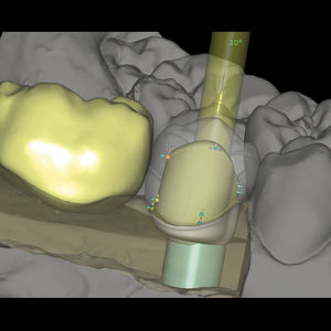 Software-Modul / für Zahnprothese-Design / Fertigung / für Dentallabor