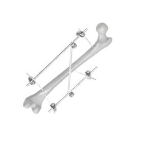 Fixateur externe / für Oberschenkelknochen