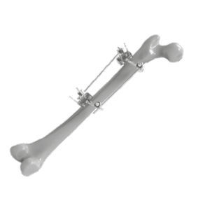 Fixateur externe / für Oberschenkelknochen