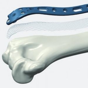Kompressionsplatte für Humerus 1