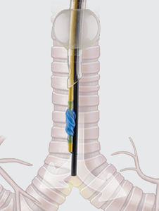 doppellumiger Endobronchialblocker 1