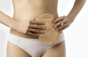 Ileostomiebeutel 1