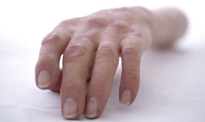 Kosmetische Armprothese