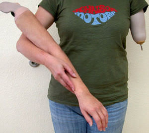 Kosmetische Armprothese 1