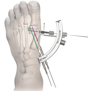 Instrumentenset / minimal-invasive Vorderfußchirurgie