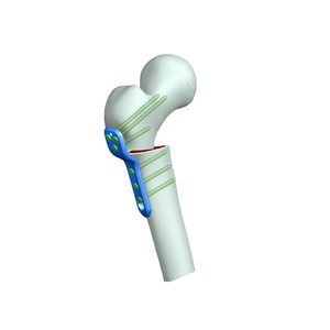 Osteotomieplatte für Oberschenkelknochen