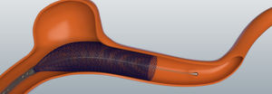 Intrakranieller Stent