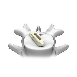LWS-Zwischenwirbelimplantat