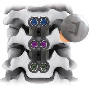 Arthrodeseplatte für Halswirbel 1