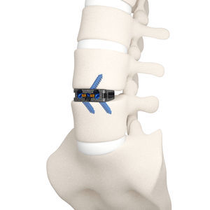 LWS-Zwischenwirbelimplantat 1