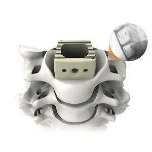 HWS-Zwischenwirbelimplantat 1