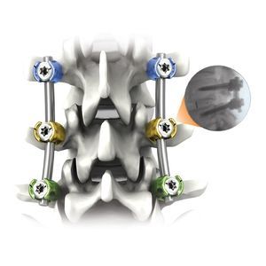 thorako-lumbales Stabilisierungssystem für Osteosynthese 1