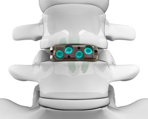 LWS-Zwischenwirbelimplantat 1