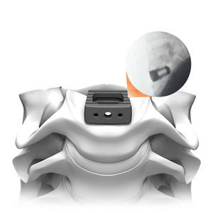 HWS-Zwischenwirbelimplantat 1