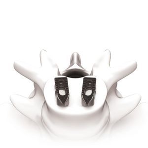 thorako-lumbales Zwischenwirbelimplantat 1