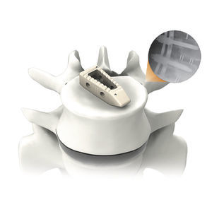 thorako-lumbales Zwischenwirbelimplantat 1