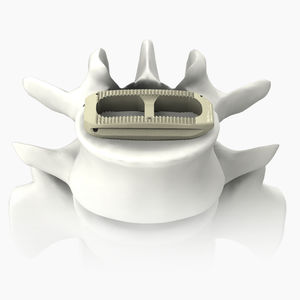 LWS-Zwischenwirbelimplantat