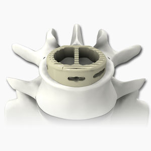 LWS-Zwischenwirbelimplantat 1