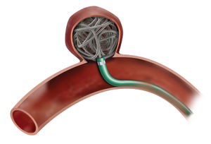 Embolisationsspirale
