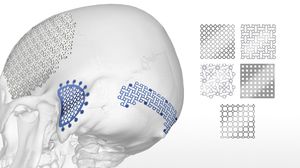 Schädelimplantat