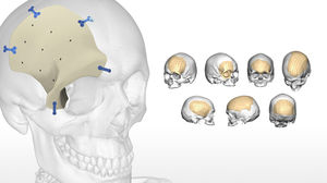 patientenspezifisches Schädelimplantat