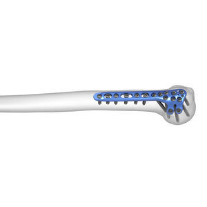 Kompressionsplatte für Humerus 1