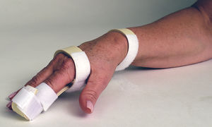 Fingerschiene 1