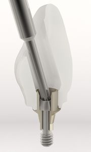 Implantat-Abutment / Titan 1